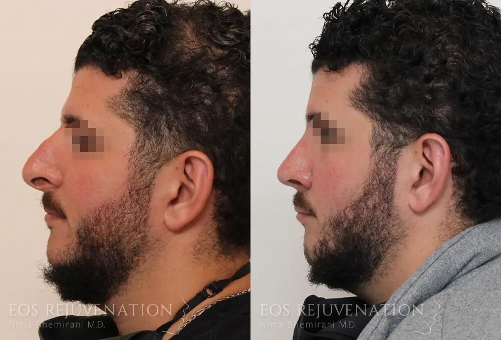 Revision Rhinoplasty Before & After