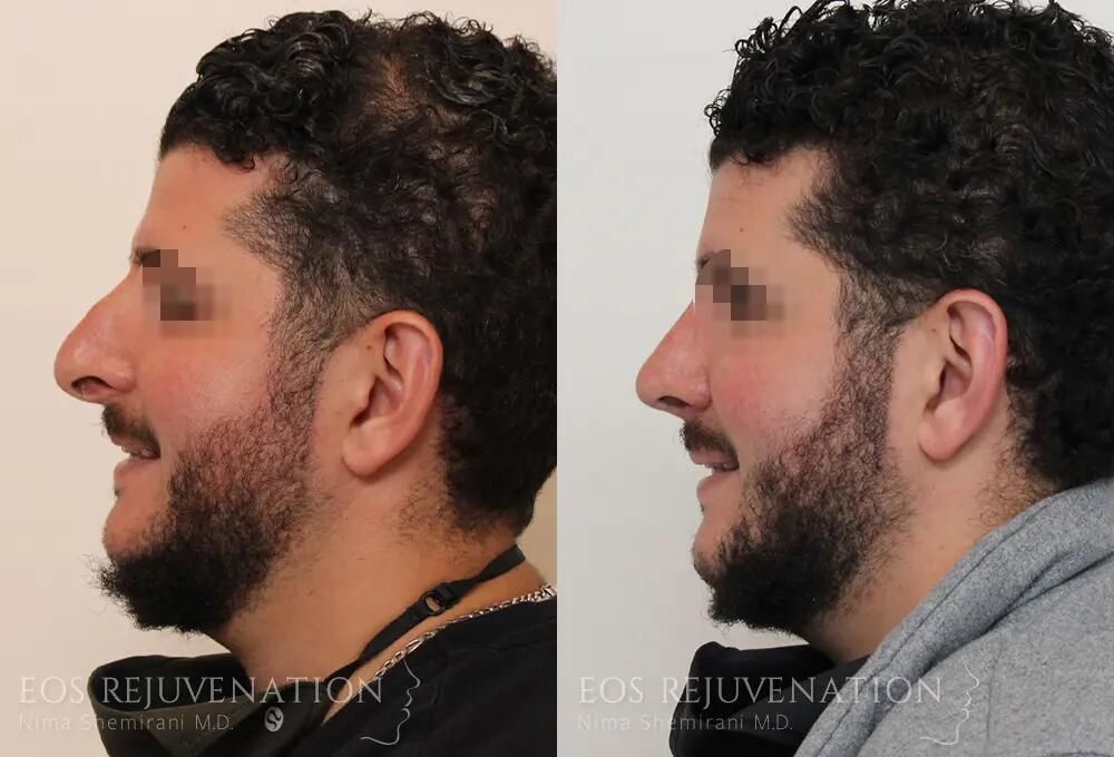 Revision Rhinoplasty Before & After