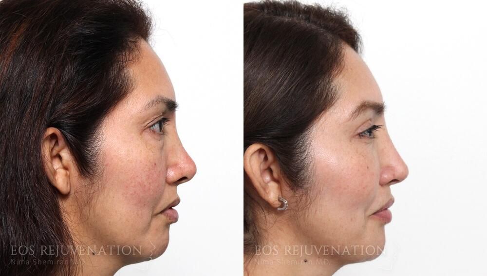 Revision Rhinoplasty Before & After