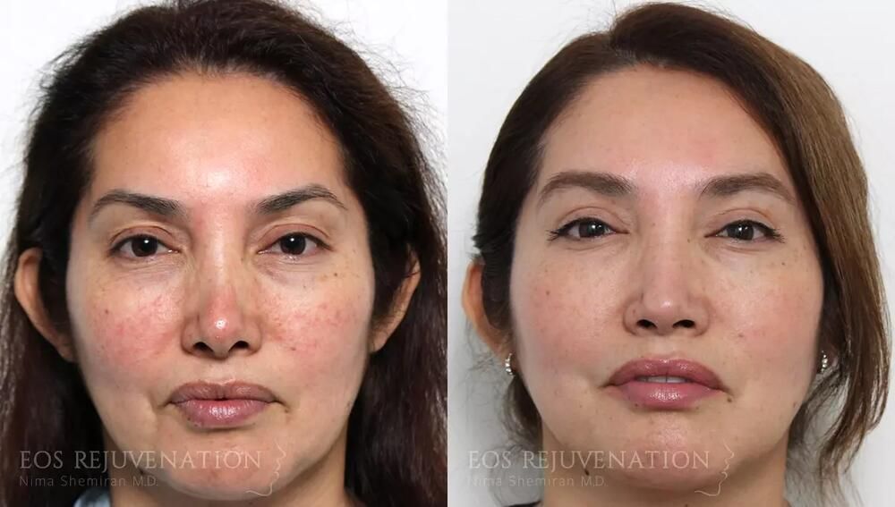 Revision Rhinoplasty Before & After