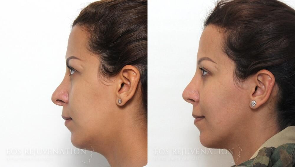 Revision Rhinoplasty Before & After
