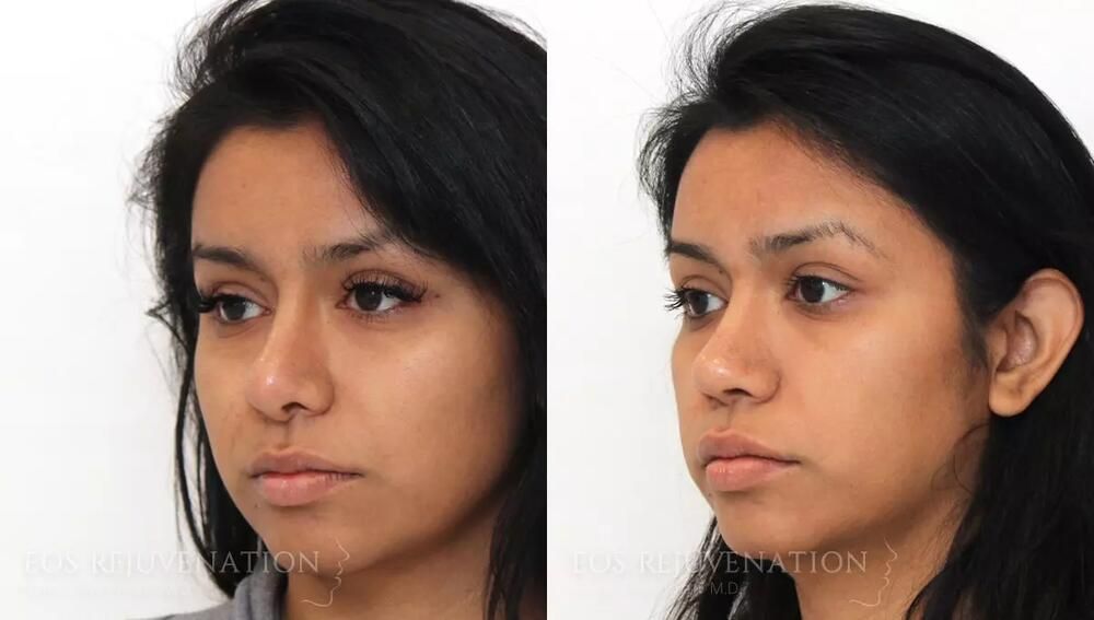 Revision Rhinoplasty Before & After