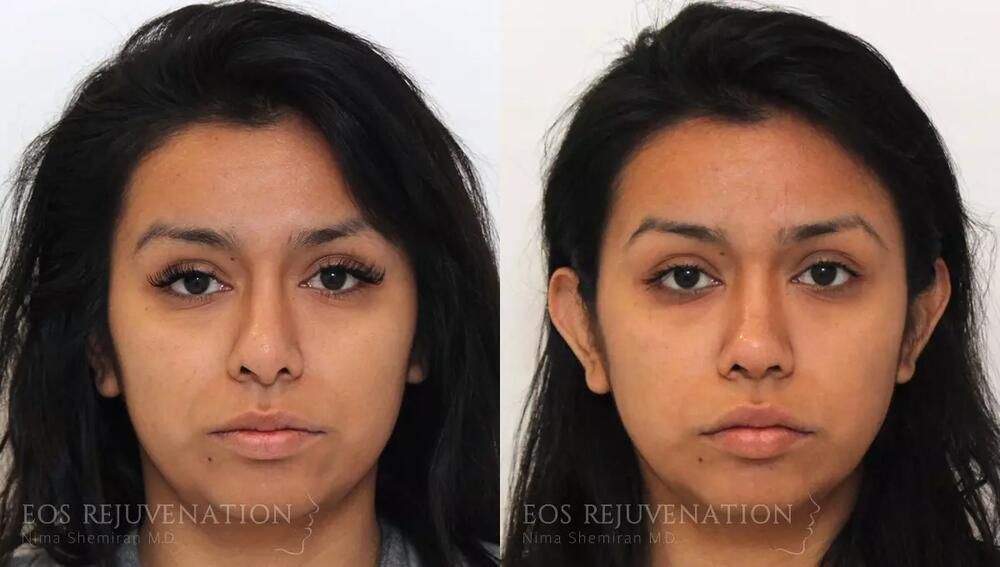 Revision Rhinoplasty Before & After