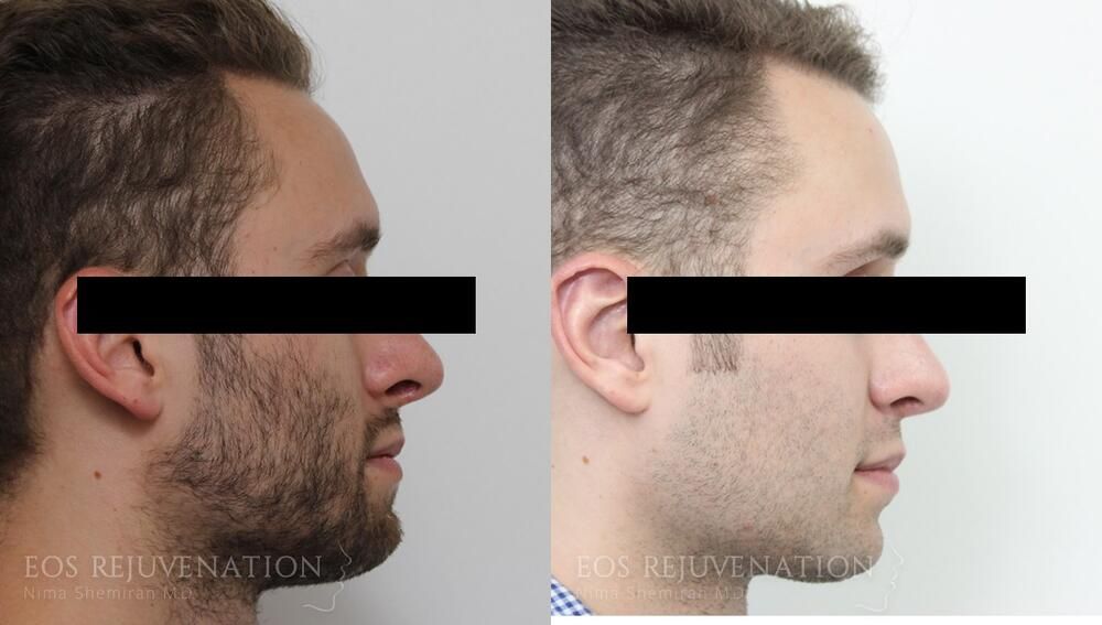 Revision Rhinoplasty Before & After