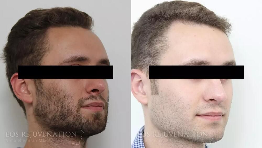 Revision Rhinoplasty Before & After