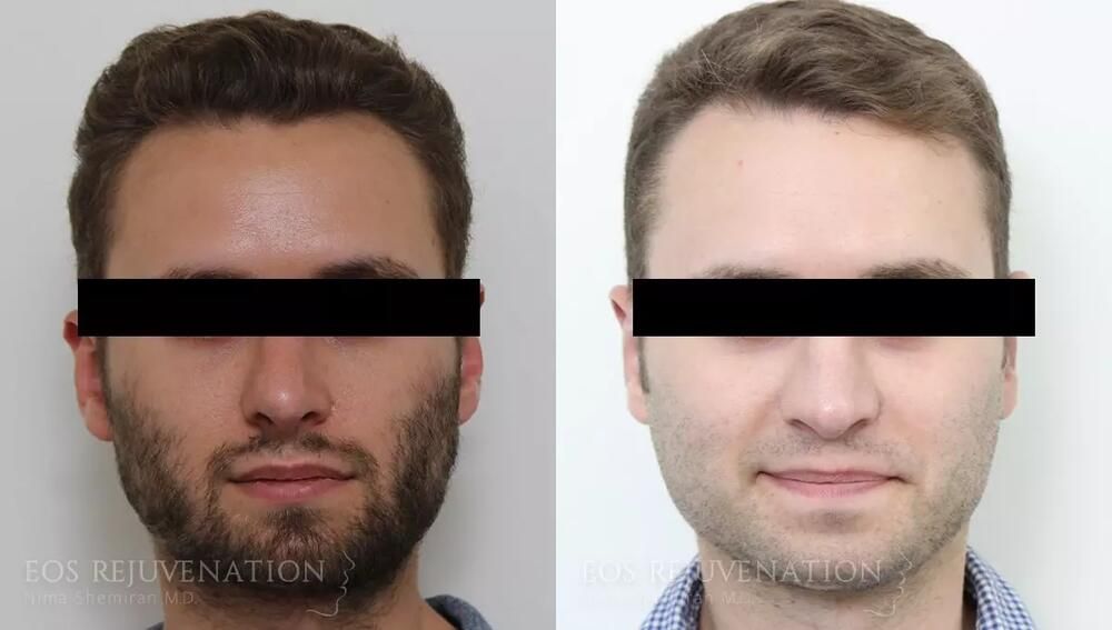 Revision Rhinoplasty Before & After