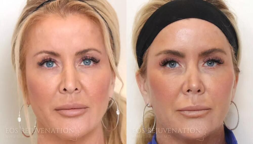 Revision Rhinoplasty Before & After