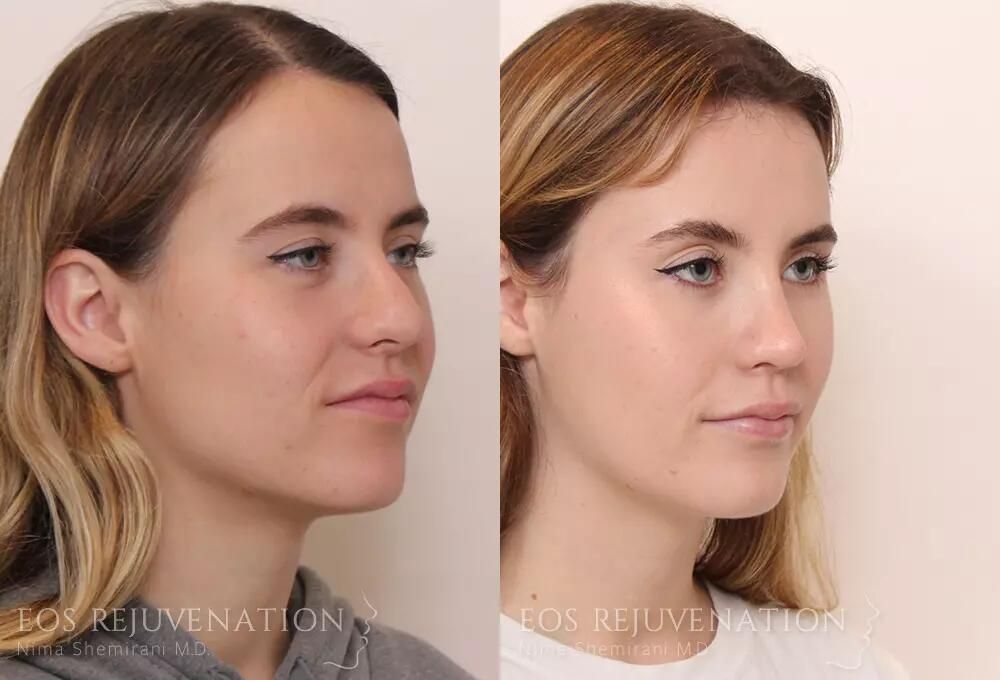 Revision Rhinoplasty Before & After