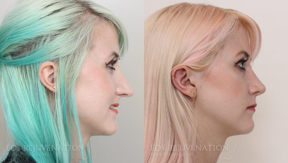 Revision Rhinoplasty Before & After
