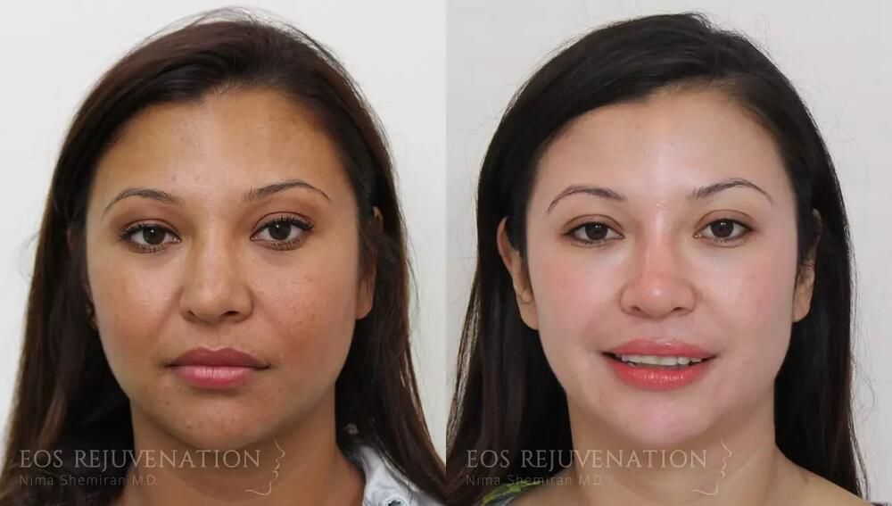 Revision Rhinoplasty Before & After