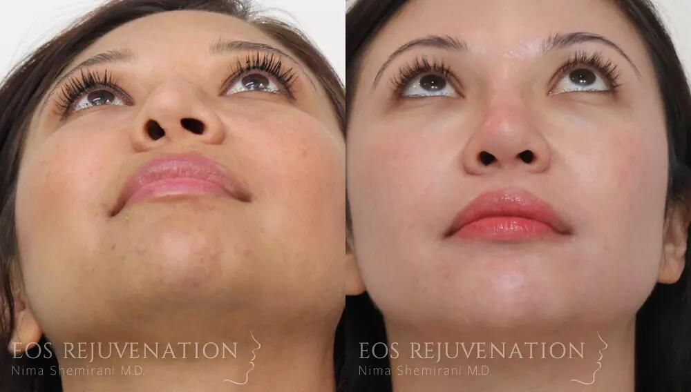 Revision Rhinoplasty Before & After
