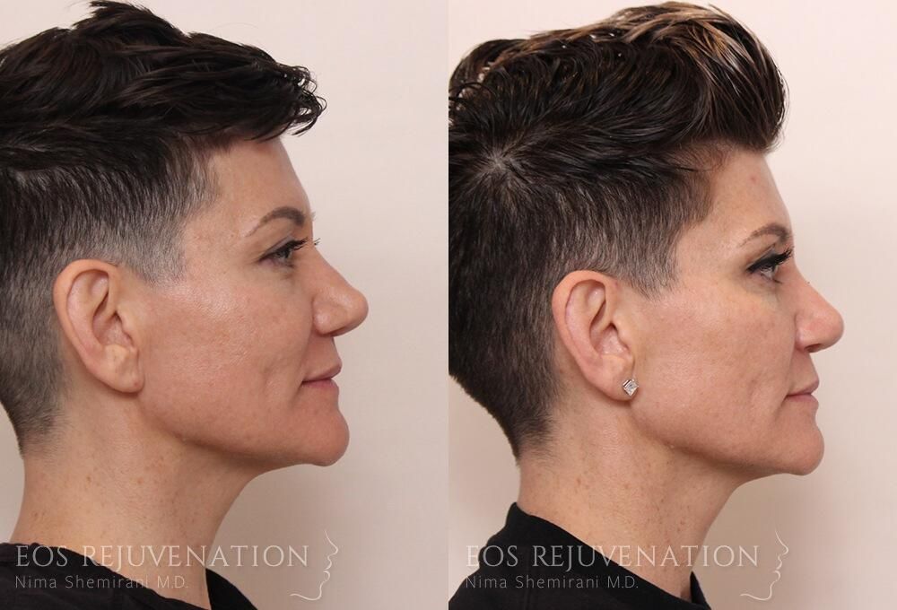 Revision Rhinoplasty Before & After