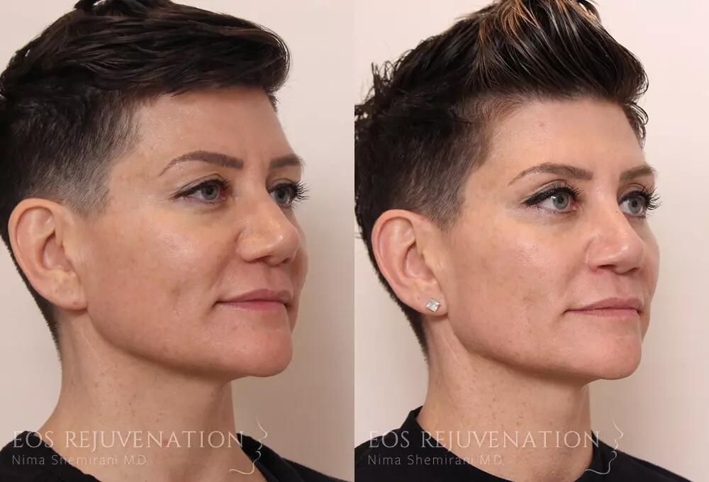 Revision Rhinoplasty Before & After