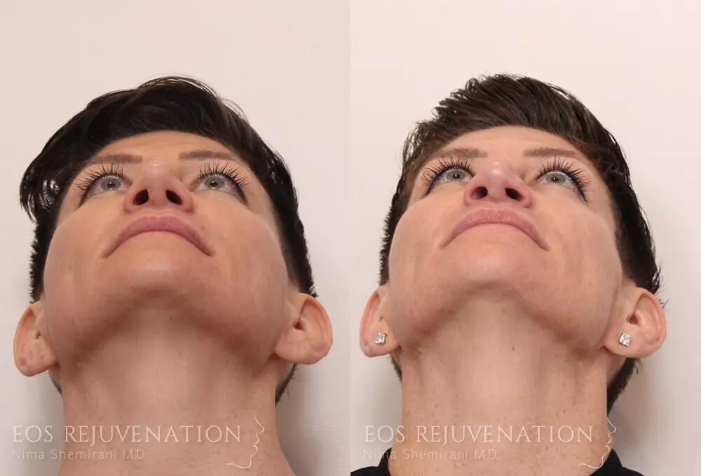Revision Rhinoplasty Before & After