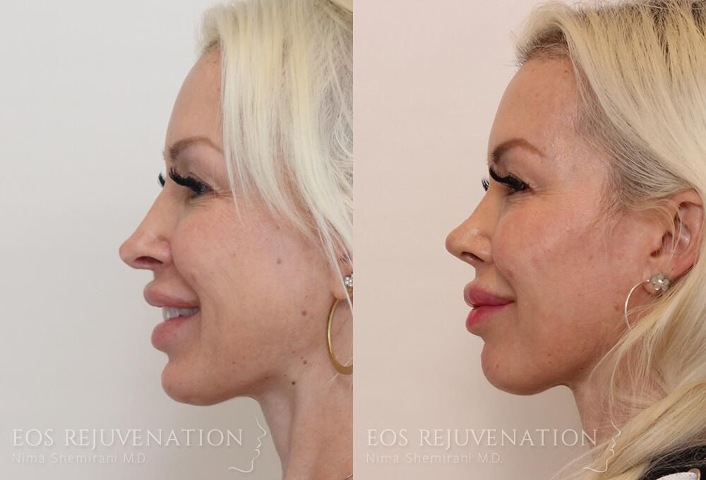 Revision Rhinoplasty Before & After
