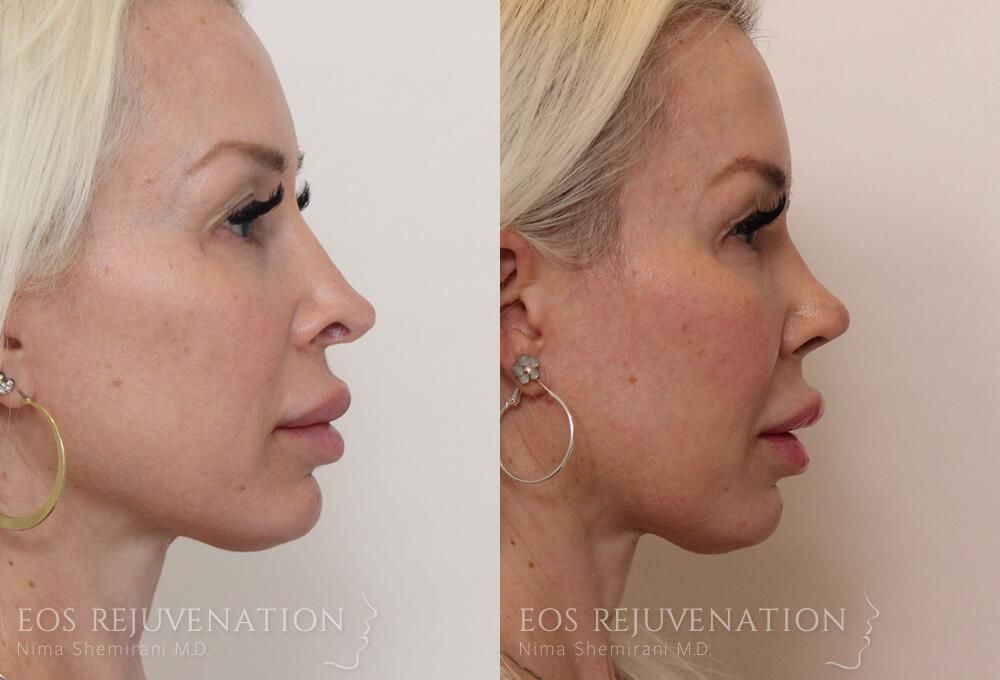 Revision Rhinoplasty Before & After