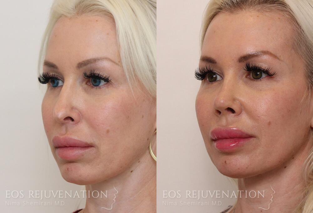 Revision Rhinoplasty Before & After