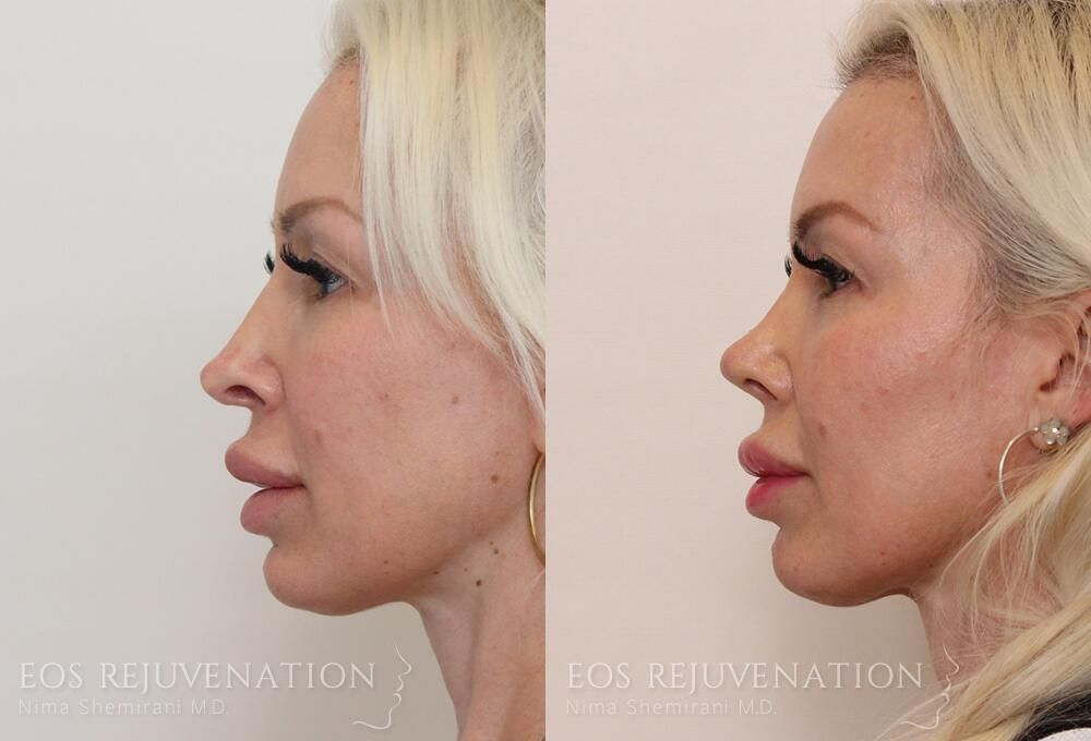 Revision Rhinoplasty Before & After