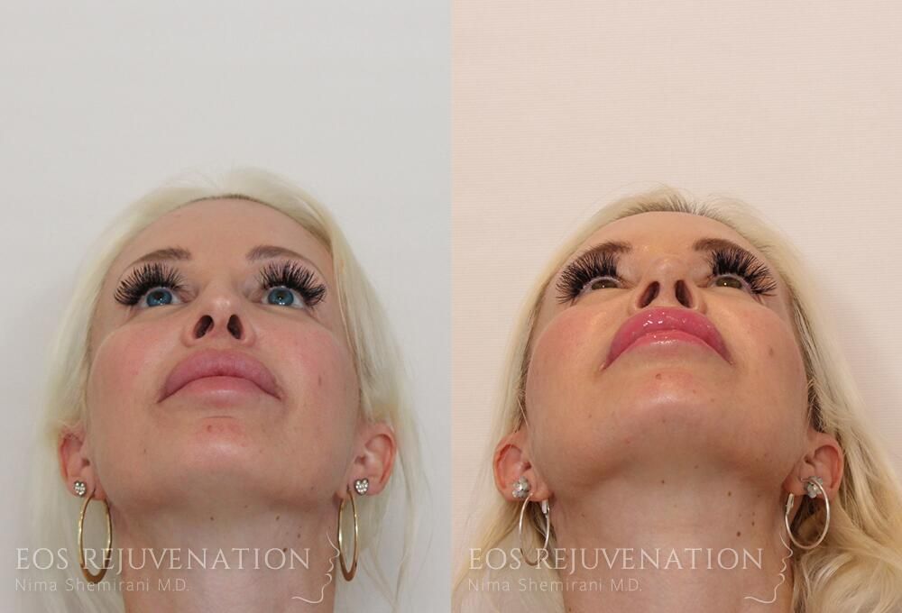 Revision Rhinoplasty Before & After