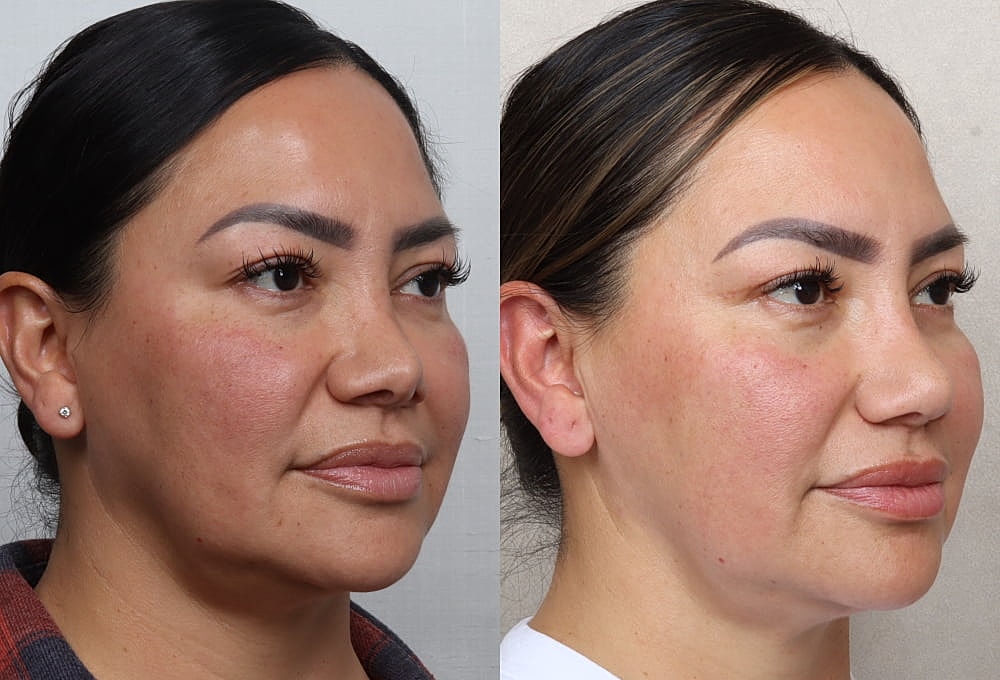 Before and after facial enhancement comparison.