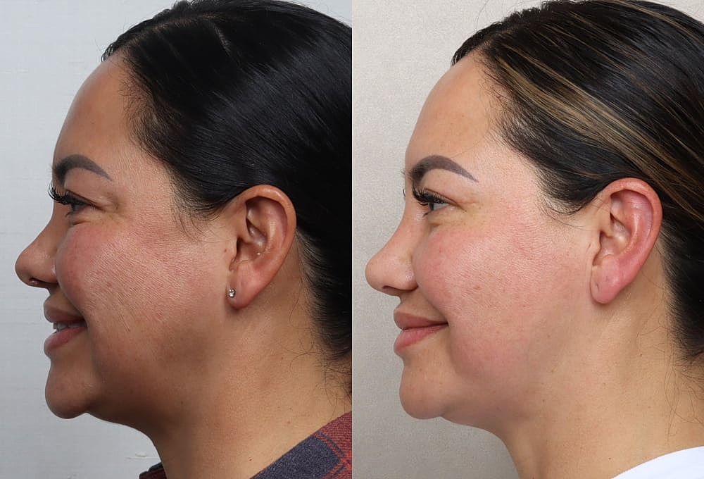 Before and after facial treatment results.