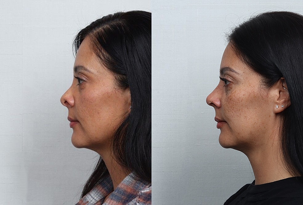 Revision Rhinoplasty Before & After