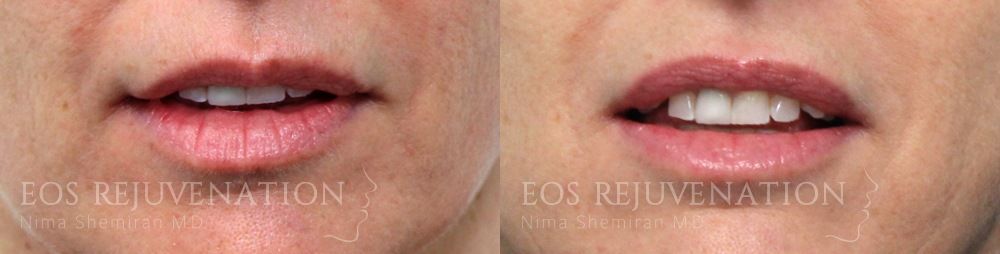 Lip Filler Before & After