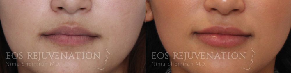 Lip Filler Before & After