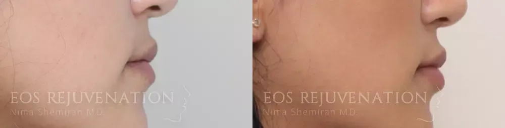 Lip Filler Before & After