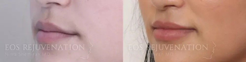 Lip Filler Before & After