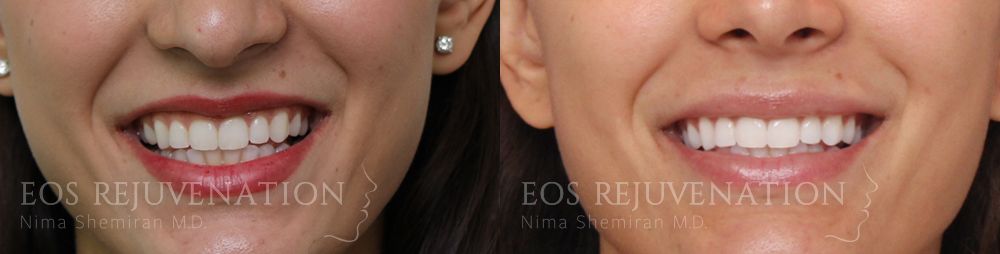 Lip Filler Before & After