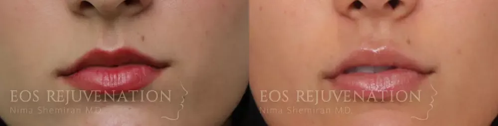 Lip Filler Before & After