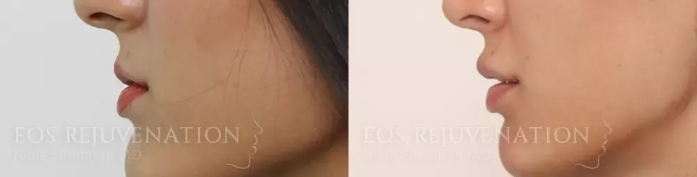 Lip Filler Before & After