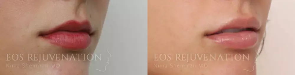 Lip Filler Before & After