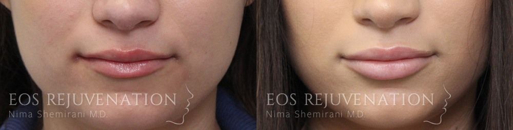 Lip Filler Before & After