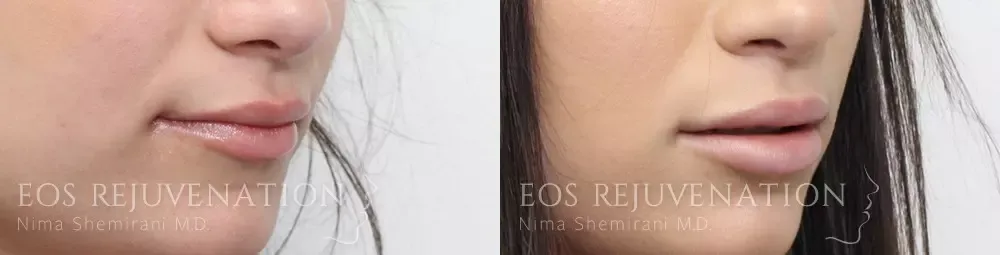 Lip Filler Before & After