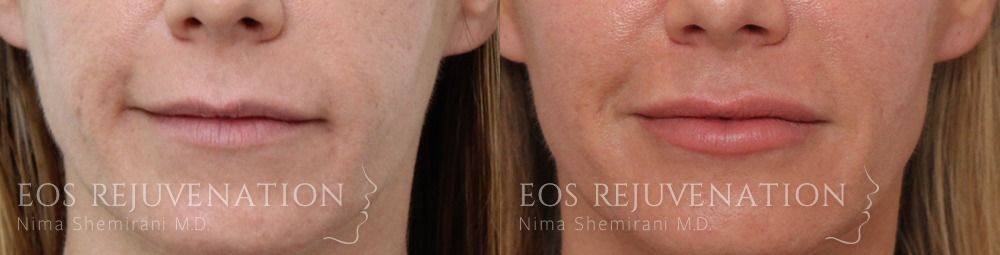 Lip Filler Before & After