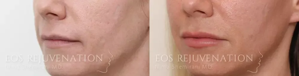 Lip Filler Before & After