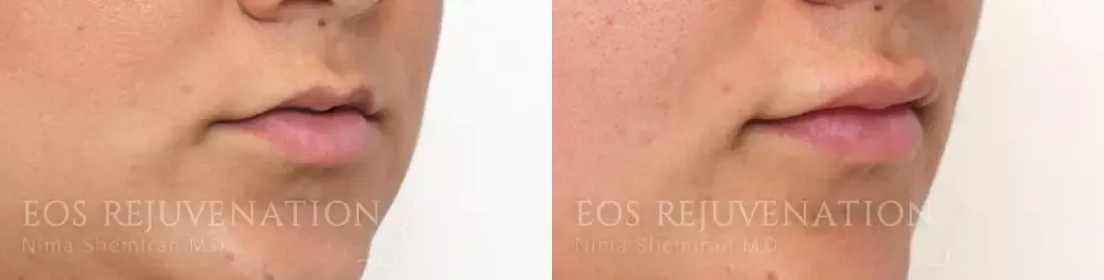 Lip Filler Before & After