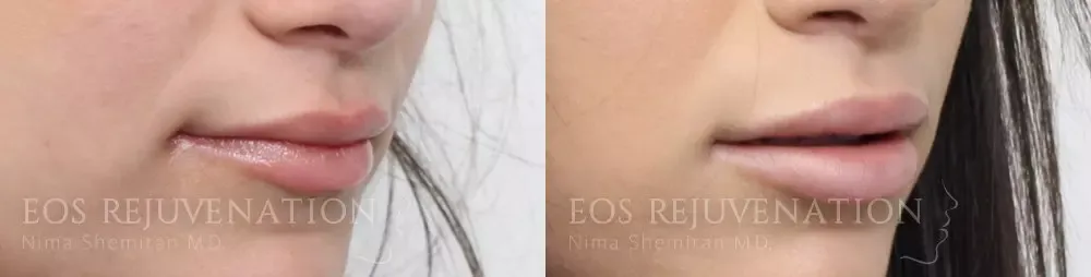 Lip Filler Before & After