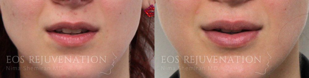 Lip Filler Before & After