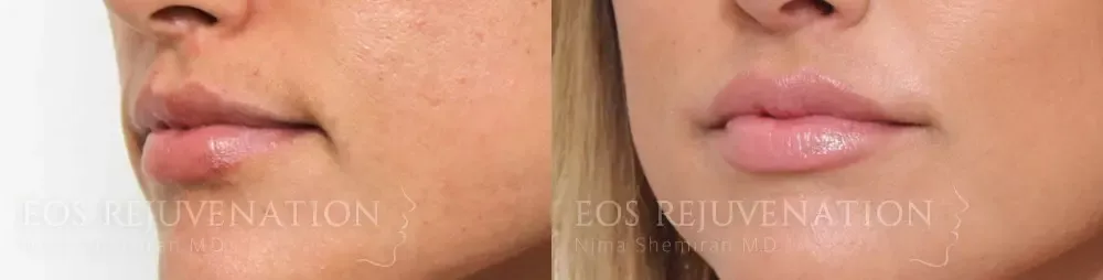 Lip Filler Before & After