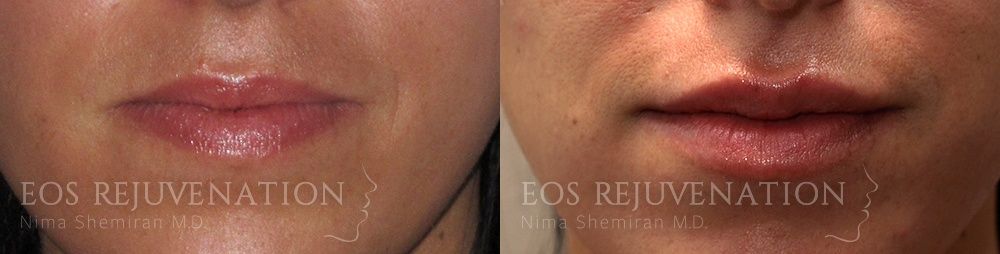 Lip Filler Before & After