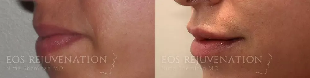 Lip Filler Before & After