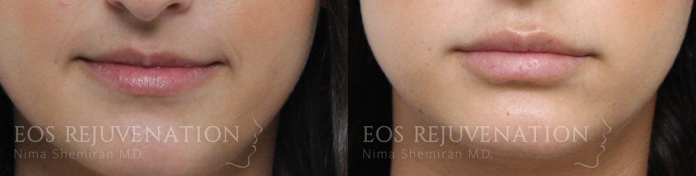 Lip Filler Before & After