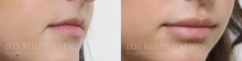 Lip Filler Before & After