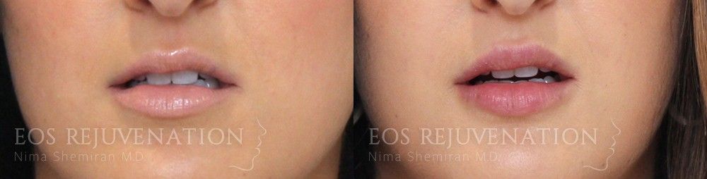 Lip Filler Before & After