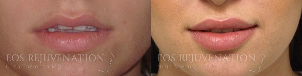 Lip Filler Before & After