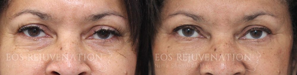 Lower Blepharoplasty Before & After