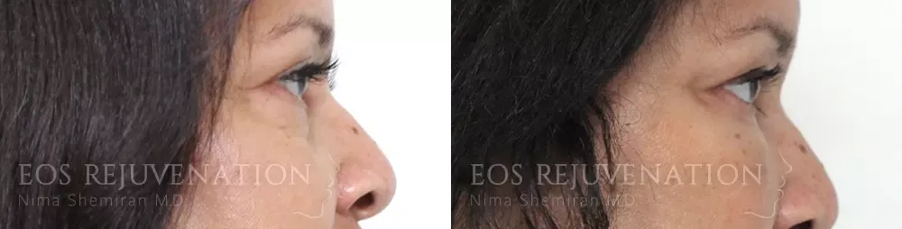 Lower Blepharoplasty Before & After